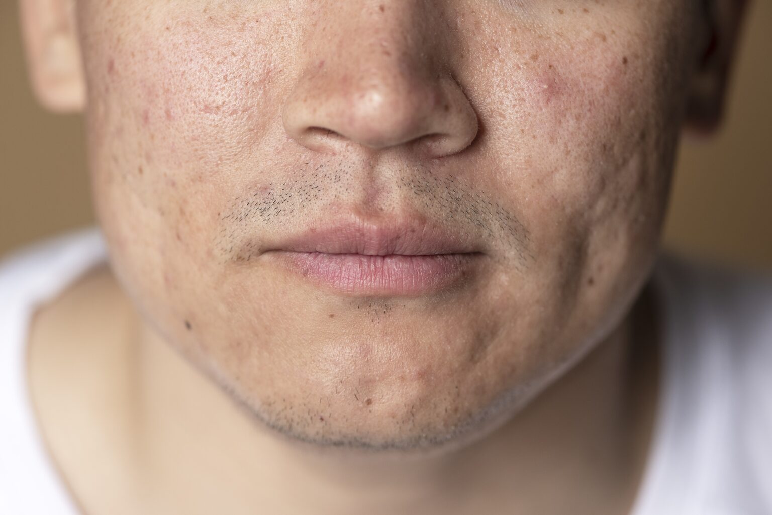 De wondere wereld van littekens Ontstaan, soorten en behandeling. - DO